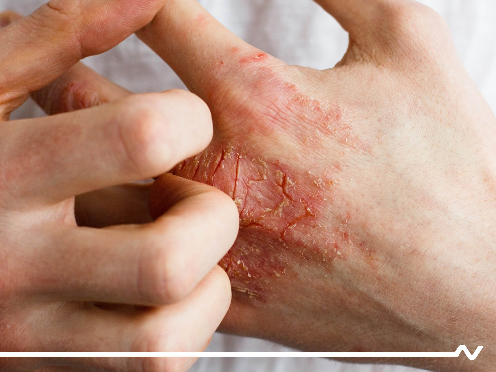 Rissige, juckende Haut am Handrücken kann auf eine berufsbedingte Hauterkrankung hinweisen.